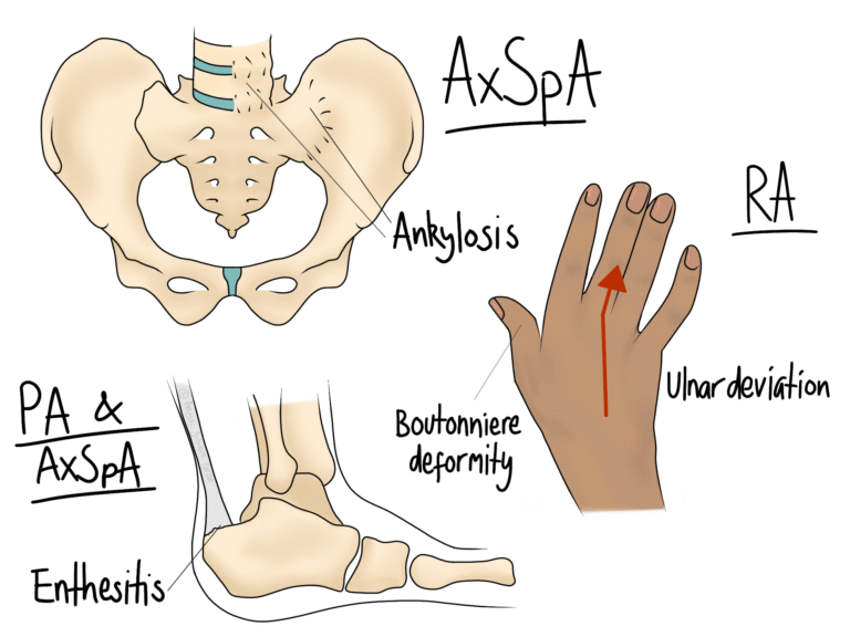 Rheumatic+(1)